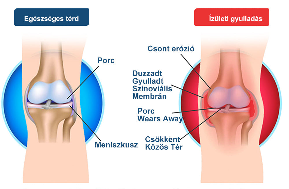 (Specjalnie dla osób starszych i zalecany przez AAOS) ArthroEase 🌱  Krem do leczenia zapalenia stawów z jadem pszczelim